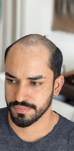 Before hair patch consultation at Elevate Salon Aurangabad